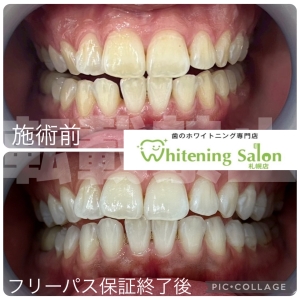 【眼精疲労からくる歯痛】