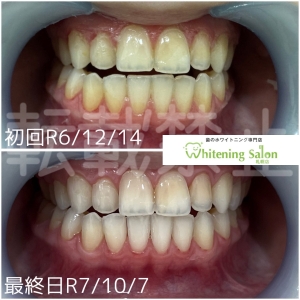 【差し歯の黄ばみ】大通り/ホワイトニング