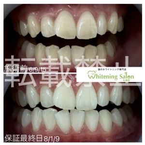 【赤ちゃんが虫歯にならないように】すすきの/ホワイトニング