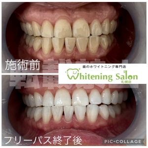 【犬歯の役割って？】札幌/ホワイトニング