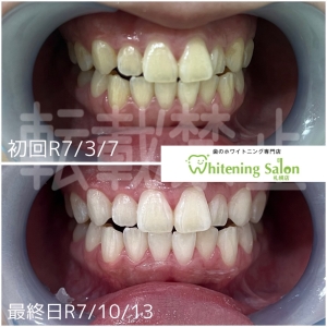 【黄ばんだ差し歯を白く改善】中央区/ホワイトニング