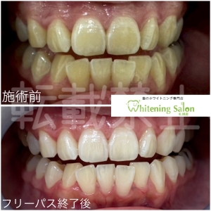 【歯石の放置は危険】大通り/ホワイトニング