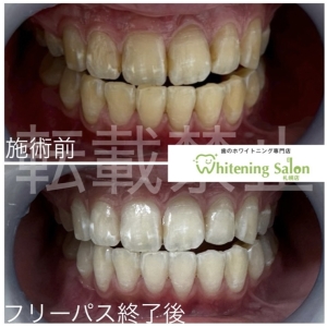 【歯周病と歯肉炎の違い】すすきの/ホワイトニング