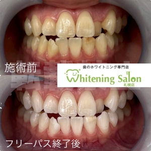 【水を飲んで歯周病予防！】札幌/ホワイトニング