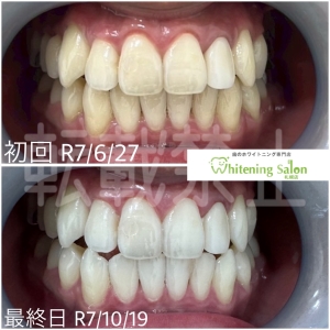 【就活をするならホワイトニング】札幌/ホワイトニング