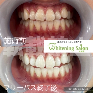 【よく噛んで健康な体に！】札幌/ホワイトニング