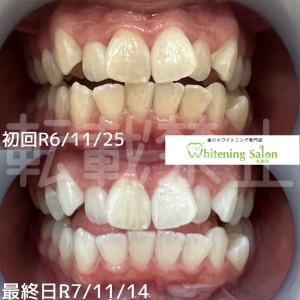 【筋トレしてる人の歯】大通り/ホワイトニング