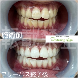 【中高年は歯が黄色い】中央区/ホワイトニング