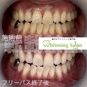 【口臭対策にマウスウォッシュ！】札幌/ホワイトニング