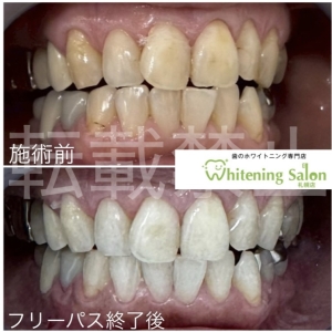 【磨いた後のコーヒーは飲んでいい？】札幌/ホワイトニング