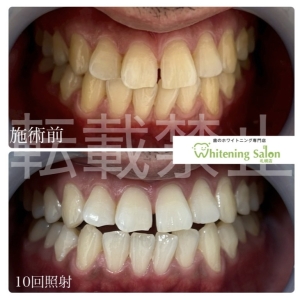 【プラークコントロールを効率的に】すすきの/ホワイトニング