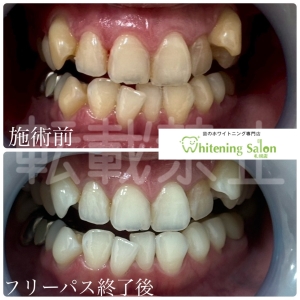 【永久歯が元々黄色い】すすきの/ホワイトニング