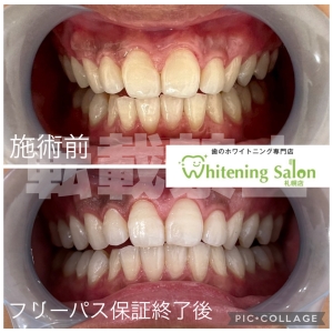 【歯のトラブルを未然に防ぐ】札幌/ホワイトニング