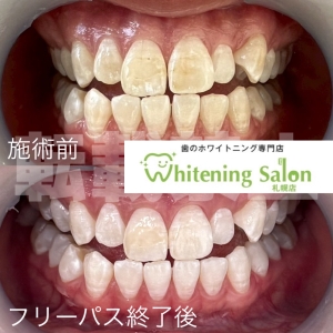 【虫歯は自然治癒する？】札幌/ホワイトニング