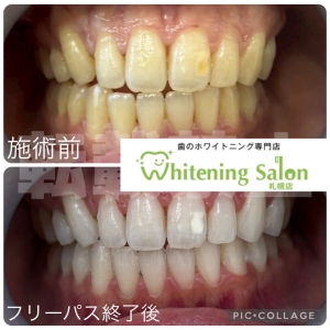【親知らずが生える前兆】札幌/ホワイトニング