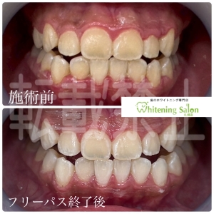 【歯茎がボコボコしている】中央区/ホワイトニング