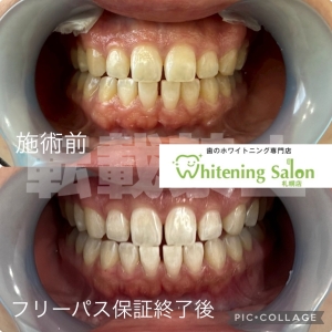 【おやつを食べる時の注意点！】札幌/ホワイトニング