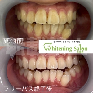 【舌磨きの効果】札幌/ホワイトニング