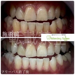 【親知らずが生える人と生えない人】大通り/ホワイトニング