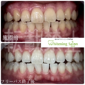 【虫歯じゃないのに甘いものがしみる】大通り/ホワイトニング