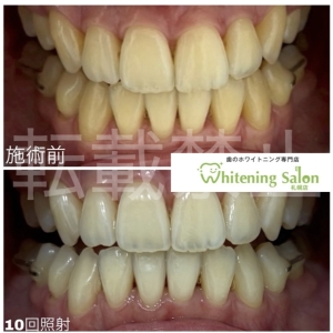 【虫歯ないのに痛い】すすきの/ホワイトニング